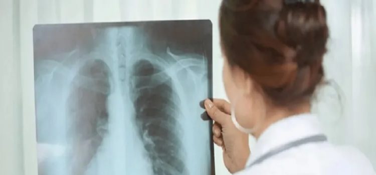Alerta sanitaria en Entre Ríos: Los casos de tuberculosis aumentaron casi un 39% en lo que va de 2026